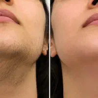 لیزر فول بادی با تخفیف