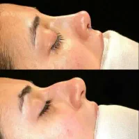 جراحی بینی با بیمه توسط متخصص گوش ،حلق،بینی|خدمات آرایشگری و زیبایی|تهران, جهاد|دیوار