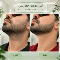لیزر مو زائد آقایان