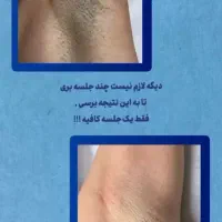 لیزر فقط ‌فقط 690تومان|خدمات آرایشگری و زیبایی|گنبد کاووس, |دیوار