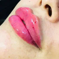 فیلر کل نواحی صورت
