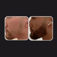 رویش مجدد ریش