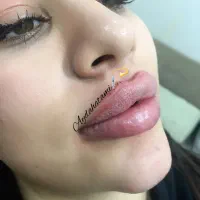 تزریق ژل و بوتاکس توسط پیرا پزشک مجرب|خدمات آرایشگری و زیبایی|اهواز, پادادشهر|دیوار