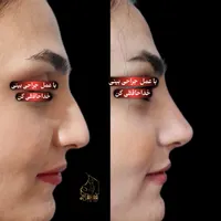 اصلاح قوز و افتادگی بینی بدون جراحی در مطب20%تخفیف|خدمات آرایشگری و زیبایی|شاهین‌شهر, فردوسی|دیوار