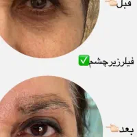 تخفیفات استثنایی ژل و بوتاکس در مطب زیبایی|خدمات آرایشگری و زیبایی|قم, دورشهر|دیوار