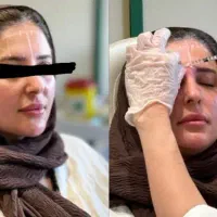 بوتاکس مصپورت صورت توسط پزشک فقط 900  تومان
