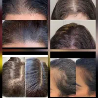 تقویت ابرو مژه مو