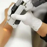 اپراتور لیزر خانم