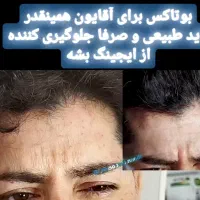 بوتاکس طبیعی درهرسنی|خدمات آرایشگری و زیبایی|رشت, بلوار گیلان|دیوار