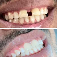 کامپوزیت دندان