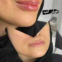 لیزر موهای زاید تزریق بوتاکس وژل  توسط پزشک|خدمات آرایشگری و زیبایی|تالش, هشتپر|دیوار