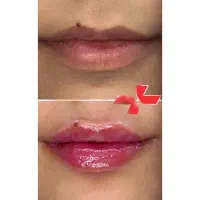 فیلر لب ،شقیقه، چانه،زاویهفک طبیعی با تکنیکتخصصی|خدمات زیبایی و سلامت|شیراز, معالیآباد|دیوار