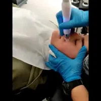 پاکسازی تخصصی پوست ـ مزو ام دی ـ مزونیدلینگ