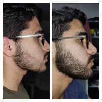 به کمترین هزینه ریشاتو پرپشت کن