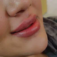 خدمات فیلر و بوتاکس