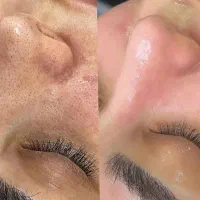 پاکسازی تخصصی پوست فقط ۵۰۰