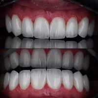 تخفیف کامپوزیت توسط پزشک ماهر