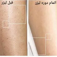 لیزر موهای زائد|خدمات آرایشگری و زیبایی|فولادشهر, B5|دیوار