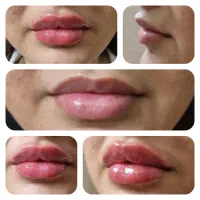 فیلر و بوتاکس و مزوتراپی در کلینیک زیبایی