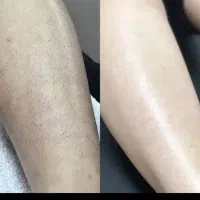 اف ویژه لیزر
