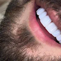 دندانسازی دندان مصنوعی طرح لمینت|خدمات زیبایی و سلامت|مشهد, عامل|دیوار