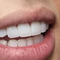 کامپوزیت و لمینت تخصصی دندان/ پرداخت اقساط دو سال