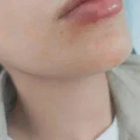 ژل و بوتاکس ،جوانسازی