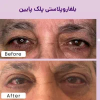 عمل زیبائی پلک پائین شامل پف ، چروک و...|خدمات آرایشگری و زیبایی|اصفهان, خلجا|دیوار