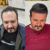 کاشت مو تبریز|خدمات آرایشگری و زیبایی|میانه, |دیوار