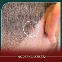 درمان کامل انواع خال و زائده های پوستی بدون بازگشت|خدمات آرایشگری و زیبایی|اصفهان, سعادت‌آباد|دیوار