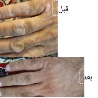 ترک پا،میخچه، اگزما|آرایشی، بهداشتی، درمانی|قروه, |دیوار