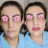 ژل و بوتاکس جشنواره تخفیف ویژه