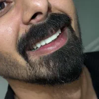 کامپوزیت/اقساط/لمینت/عصبکشی|خدمات زیبایی و سلامت|تهران, سازمان برنامه شمالی|دیوار