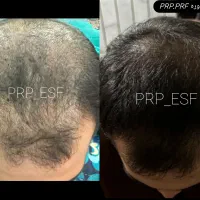 پی آر پی prp prf مزونیدلینگ زخم دیابتی کاشت مو