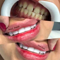 خدمات کامپوزیت مدت محدود