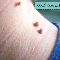 برداشتن انواع خال زگیل نشانه با مواد گیاهی تضمینی