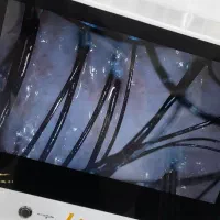 اسکراب‌اسکالپ(پاکسازی کف‌سر)+آنالیز ومشاوره رایگان|خدمات آرایشگری و زیبایی|کرج, باغستان|دیوار