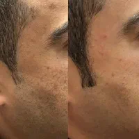 لیزر سه طول موج تیتانیوم اصل فقط اقایون|خدمات آرایشگری و زیبایی|گرگان, |دیوار