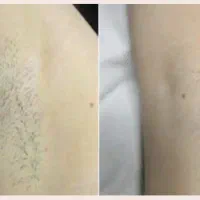 جشنواره بهاره لیزر موی زاید،زیبایی و جوانسازی