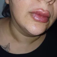 ژل،بوتاکس،آنزیم بابروز ترین متد