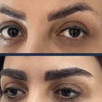 کاشت مو و ابرو