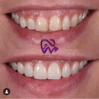 کامپوزیت دندان لبه شیشه ای فکی ۱۰ با اقساط بلندمدت|خدمات آرایشگری و زیبایی|تهران, تجریش|دیوار