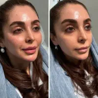 جشنواره یلدایی ژل لب کانتورینگ مزوژل لیفت صورت|خدمات آرایشگری و زیبایی|تهران, تهرانپارس جنوبی|دیوار