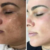 کرم درمان لکه و کک و مک و....|آرایشی، بهداشتی، درمانی|میاندوآب, |دیوار