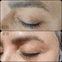 رفع اسکار بلفاروپلاستی بدون بازگشت|خدمات آرایشگری و زیبایی|اصفهان, چشمه باقرخان|دیوار