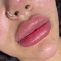 تزریق بوتاکس ۷۰۰ ژل ۵۰۰
