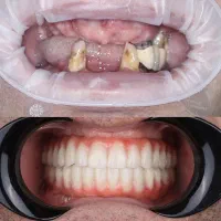 اوردنچر دو فک فقط ۱۲۷ تومن در تبریز