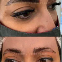 تخفیف فیبروز پاک کردن تتو کراتین