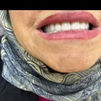 ساخت دندانهای متحرک