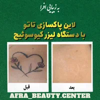 لیزر و زیبایی و پاکسازی تخصصی تاتو و سفید کنندگی